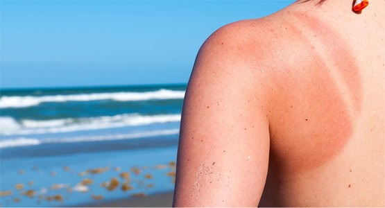 Person vid en strand med en solbränd axel